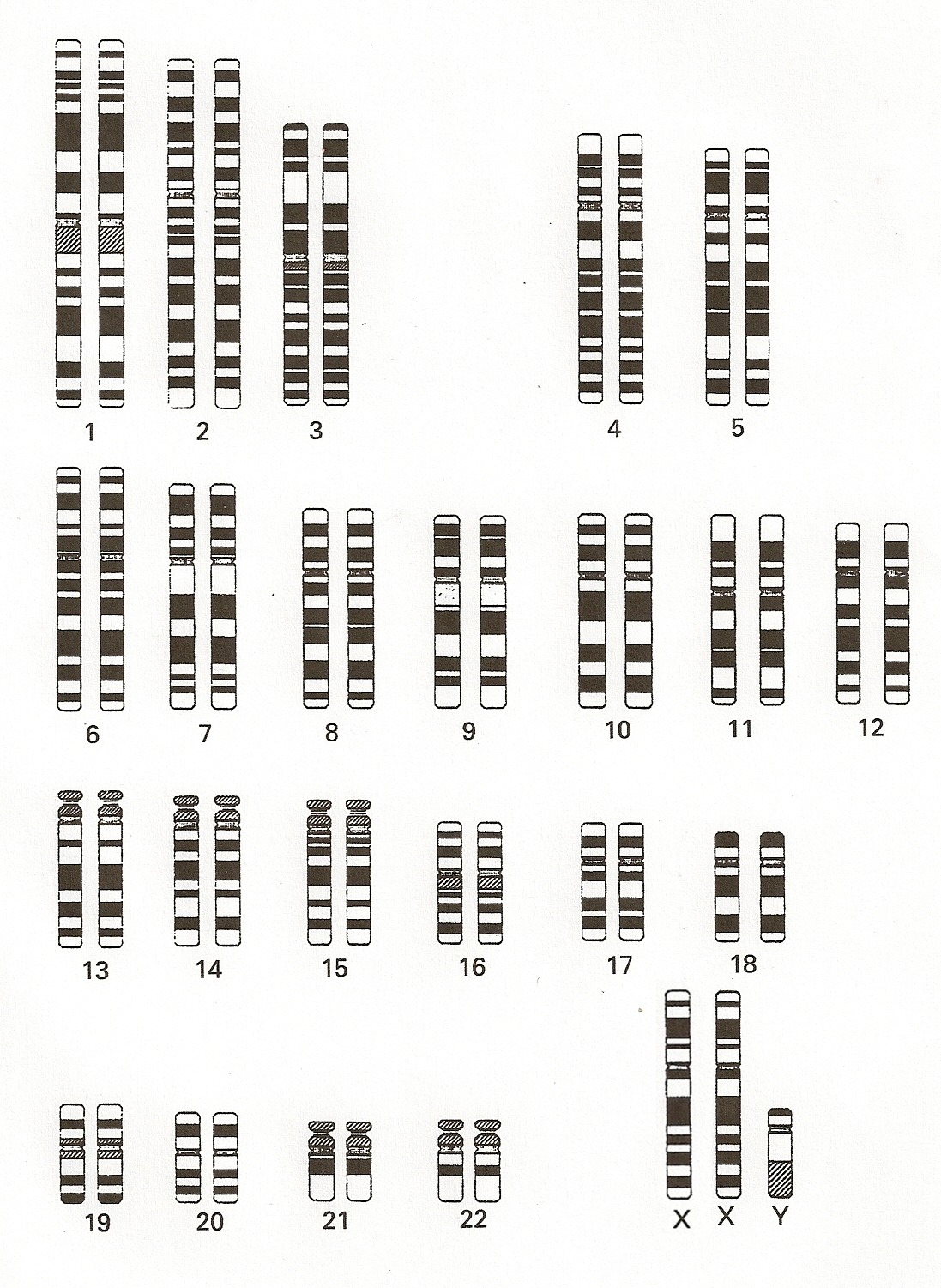 klinefelter syndrome karyotype